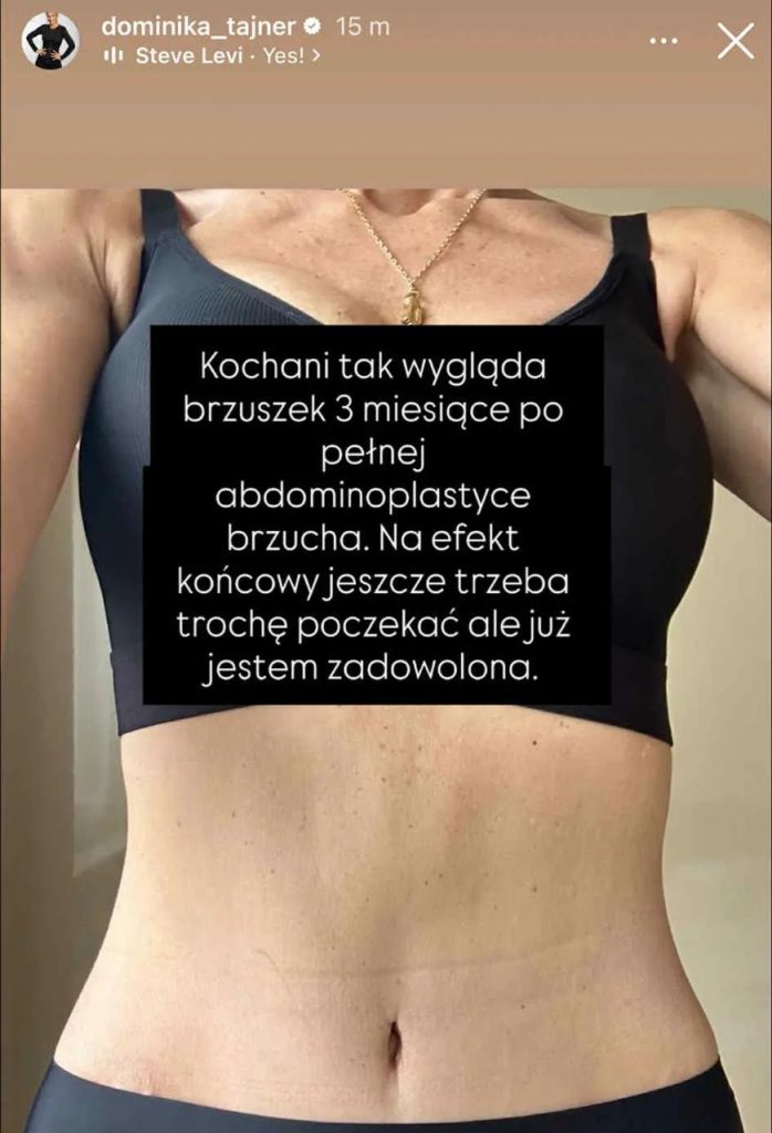 Dominika Tajner po abdominoplastyce - jak wygląda brzuch po 3 miesiącach i kiedy widać ostateczny efekt